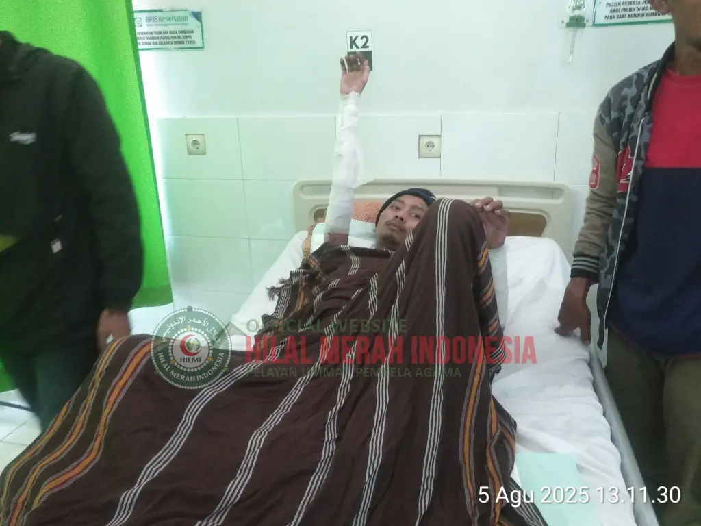 Hilmi Bantu Pasien Luka Bakar 1